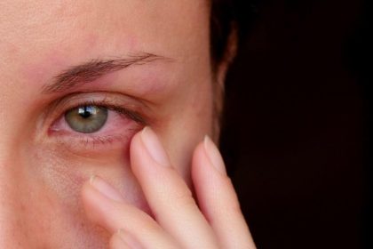 Allergies on Eye Health