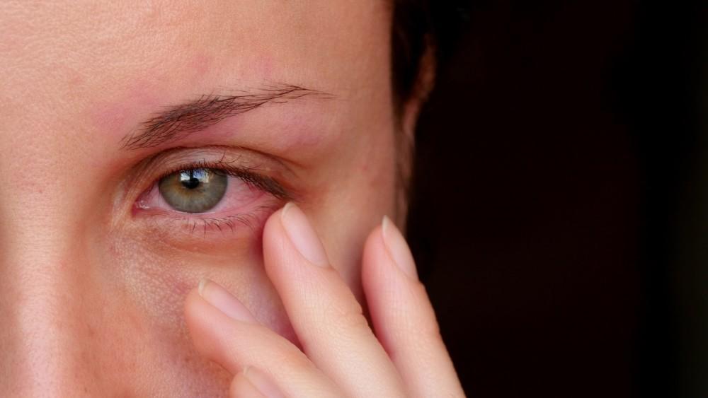 Allergies on Eye Health
