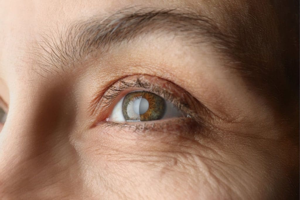 Selenium in Preventing Cataracts